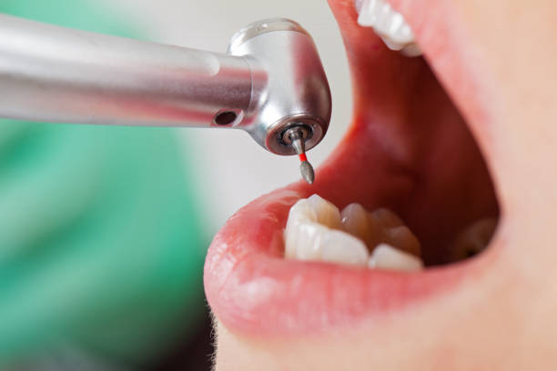 Best Chipped Tooth Repair Near Me  in Southwest Sandhill, TX